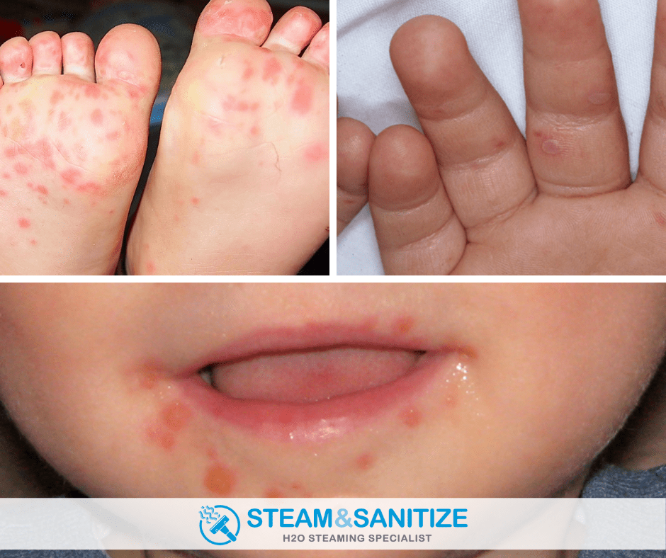 Hand Foot Mouth Disease HFMD Steam Sanitize
